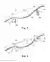 Fig. 06 - Adjustable Sling and Method of Treating Pelvic Conditions