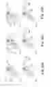 Fig. 16 - Adjustable Sling and Method of Treating Pelvic Conditions