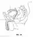 Fig. 02 - ARTIFICIAL SPHINCTER WITH PIEZOELECTRIC ACTUATOR