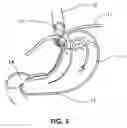Fig. 09 - ARTIFICIAL SPHINCTER WITH PIEZOELECTRIC ACTUATOR