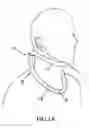 Fig. 02 - Cervical collar