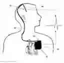 Fig. 01 - Neurostimulator