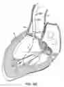 Fig. 08 - Everting heart valve
