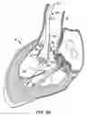Fig. 09 - Everting heart valve