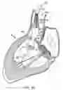 Fig. 10 - Everting heart valve