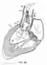 Fig. 11 - Everting heart valve