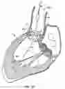 Fig. 13 - Everting heart valve