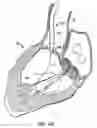 Fig. 14 - Everting heart valve