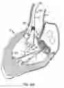 Fig. 15 - Everting heart valve