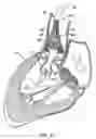 Fig. 16 - Everting heart valve