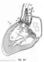 Fig. 17 - Everting heart valve