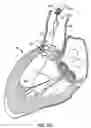 Fig. 19 - Everting heart valve