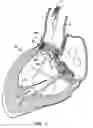 Fig. 20 - Everting heart valve