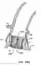 Fig. 54 - Everting heart valve