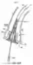 Fig. 56 - Everting heart valve
