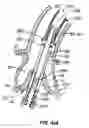 Fig. 59 - Everting heart valve