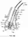Fig. 60 - Everting heart valve