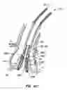 Fig. 61 - Everting heart valve