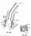 Fig. 62 - Everting heart valve