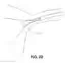 Fig. 04 - Devices and methods for occluding a fallopian tube