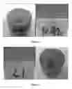 Fig. 02 - Composition and method for fluid recovery from well