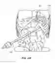 Fig. 32 - DEVICES, SYSTEM AND METHODS FOR MINIMALLY INVASIVE ABDOMINAL SURGICAL PROCEDURES