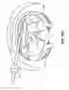 Fig. 33 - DEVICES, SYSTEM AND METHODS FOR MINIMALLY INVASIVE ABDOMINAL SURGICAL PROCEDURES