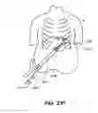 Fig. 40 - DEVICES, SYSTEM AND METHODS FOR MINIMALLY INVASIVE ABDOMINAL SURGICAL PROCEDURES