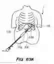 Fig. 83 - Devices, tools and methods for performing minimally invasive abdominal surgical procedures