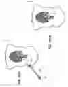Fig. 90 - Devices, tools and methods for performing minimally invasive abdominal surgical procedures