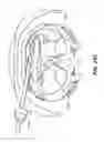 Fig. 33 - DEVICES, SYSTEM AND METHODS FOR MINIMALLY INVASIVE ABDOMINAL SURGICAL PROCEDURES