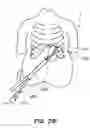 Fig. 40 - DEVICES, SYSTEM AND METHODS FOR MINIMALLY INVASIVE ABDOMINAL SURGICAL PROCEDURES