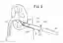 Fig. 04 - Hemostatic devices and methods for use thereof