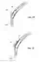 Fig. 05 - Apparatus for arthroscopic assisted arthroplasty of the hip joint