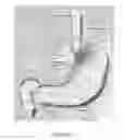 Fig. 03 - Devices and methods for treatment of gastrointestinal disorders
