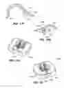 Fig. 45 - Devices, tools and methods for performing minimally invasive abdominal surgical procedures