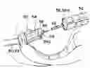 Fig. 01 - Method for anastomosis surgery using zip-ties