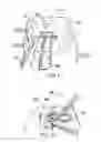 Fig. 02 - Method for anastomosis surgery using zip-ties