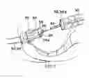 Fig. 07 - Method for anastomosis surgery using zip-ties