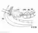Fig. 09 - Method for anastomosis surgery using zip-ties