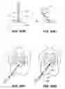 Fig. 79 - DEVICES, TOOLS AND METHODS FOR PERFORMING MINIMALLY INVASIVE ABDOMINAL SURGICAL PROCEDURES