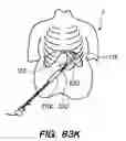 Fig. 83 - DEVICES, TOOLS AND METHODS FOR PERFORMING MINIMALLY INVASIVE ABDOMINAL SURGICAL PROCEDURES