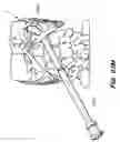 Fig. 85 - DEVICES, TOOLS AND METHODS FOR PERFORMING MINIMALLY INVASIVE ABDOMINAL SURGICAL PROCEDURES
