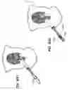 Fig. 89 - DEVICES, TOOLS AND METHODS FOR PERFORMING MINIMALLY INVASIVE ABDOMINAL SURGICAL PROCEDURES