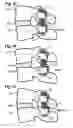 Fig. 07 - Rod-shaped implant, in particular for the dynamic stabilization of the spine