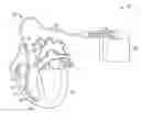 Fig. 01 - Lead assembly and related methods