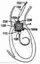 Fig. 01 - Two-step heart valve implantation