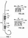 Fig. 02 - Two-step heart valve implantation