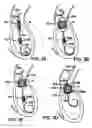Fig. 03 - Two-step heart valve implantation