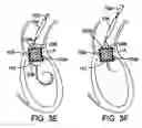 Fig. 04 - Two-step heart valve implantation